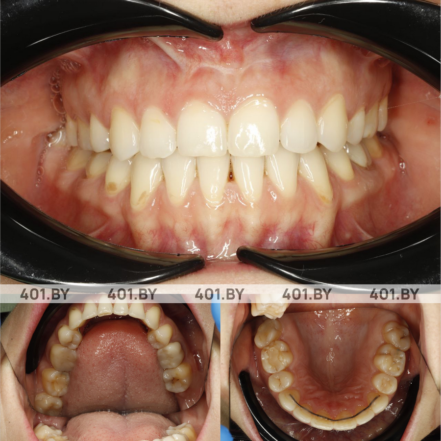 Выравнивание зубов и исправление ротации элайнерами. До