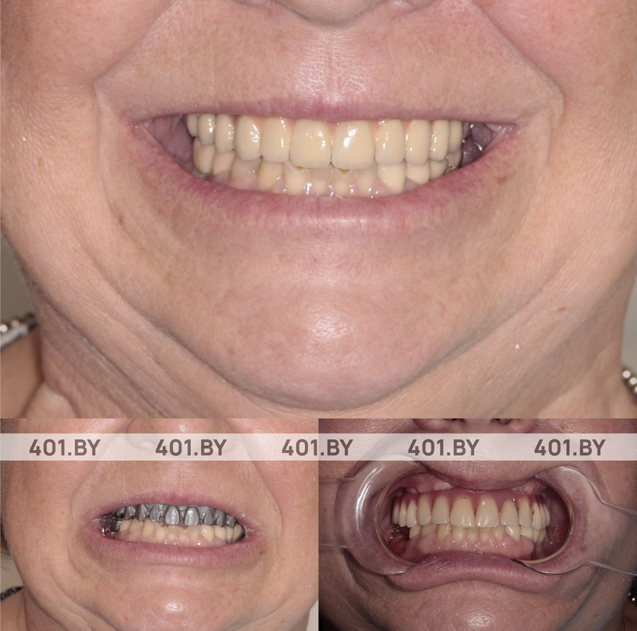 Восстановление верхней челюсти по протоколу All-on-4. До