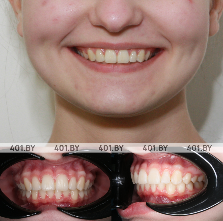 Комплексное исправление скученности и трем. До